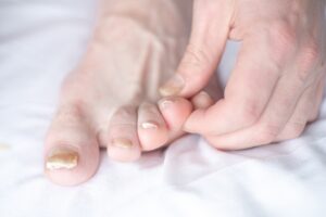 Everything You Need to Know About Nail Fungus - dermatologist in laplace