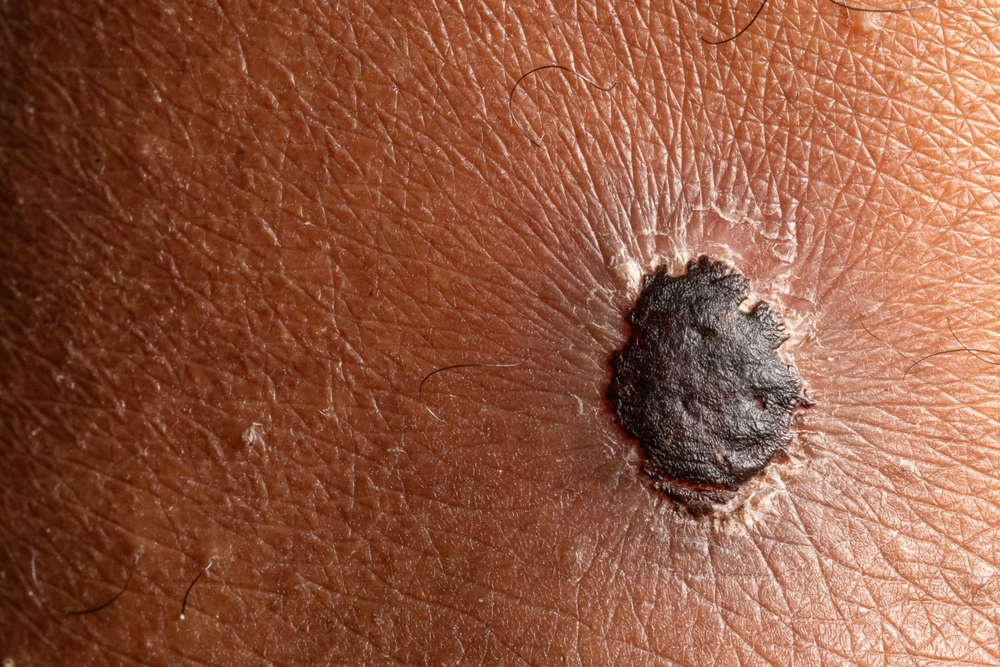 How to Know If It’s Time to See a Dermatologist - dermatology care in laplace -