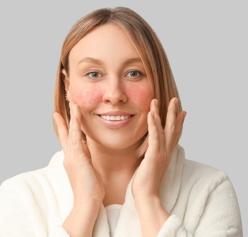 Managing Rosacea Tips to Reduce Flare-Ups and Redness - dermatologist in laplace