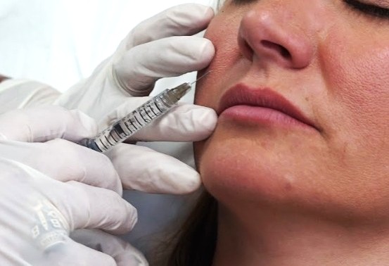 Botox vs. Fillers What’s the Difference and Which One Do You Need - dermatologist laplace - botox and fillers laplace