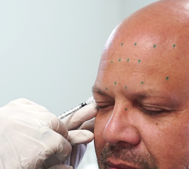 Botox-vs.-Fillers-Whats-the-Difference-and-Which-One-Do-You-Need-dermatologist-laplace-botox-and-fillers-laplace
