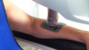 Why-You-May-Need-a-Laser-Test-Spot-Before-Your-Skin-Treatment-laser-spot-test-laplace-dermatologist-laplace