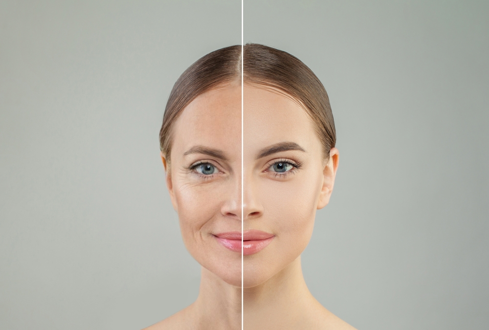 How-to-Combine-Neuromodulators-and-Fillers-for-a-Natural-Anti‑Aging-Look-laplace-dermatologist
