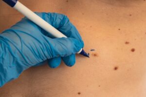 What-to-Expect-During-a-Mole-or-Cyst-Removal-Procedure-laplace-dermatologist