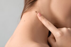 When to See a Dermatologist Signs That a Mole or Spot Needs Professional Evaluation - dermatologist laplace