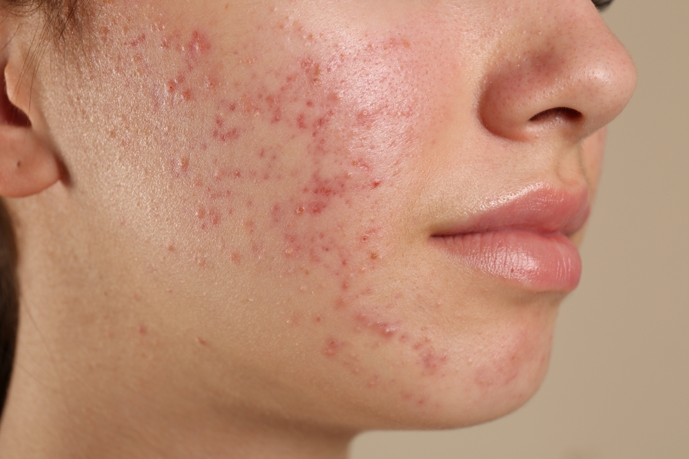 acne treatment in laplace - laplace dermatology clinic