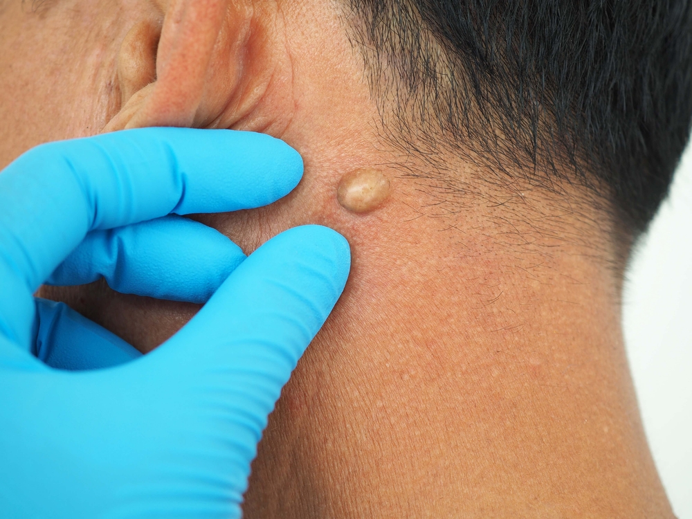 cyst treatment in laplace dermatologist clinic