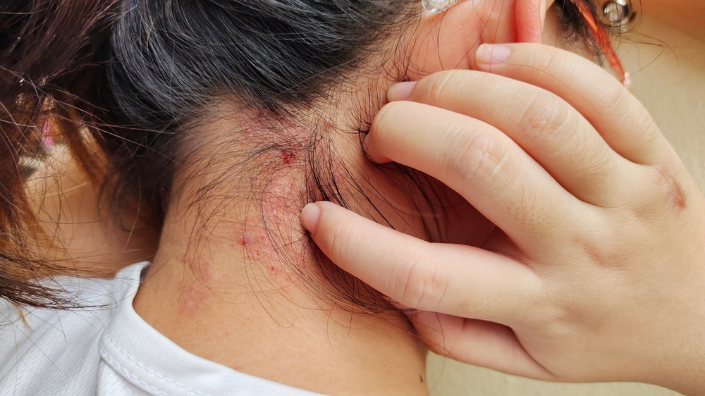 why psoriasis happen - dermatologist in laplace