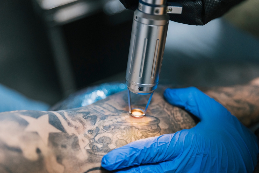 is tattoo removal safe - laplace dermatology
