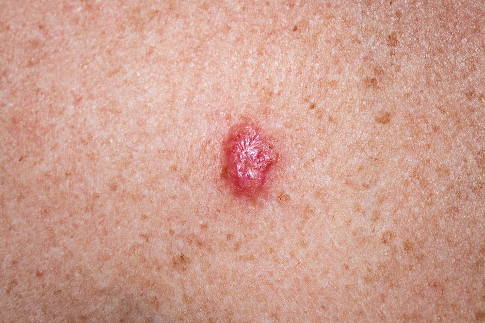 most common skin cancer type - basal cell carcinoma