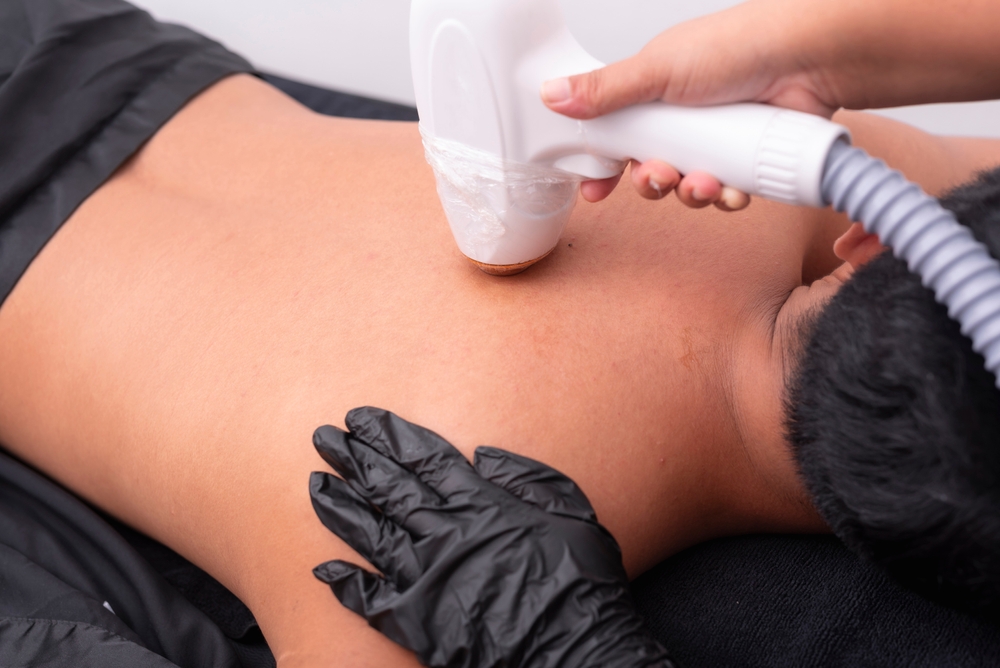 man removing back hair with laser - laplace dermatology