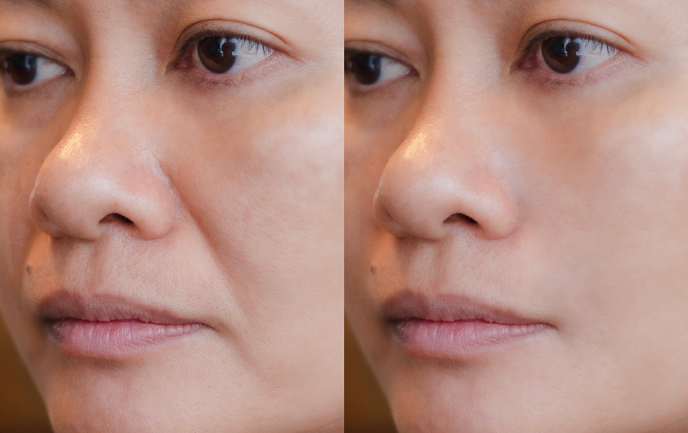 dermal fillers in laplace dermatology