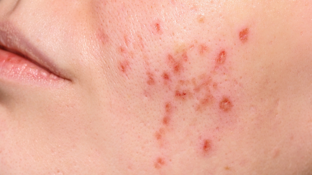 erbium peel in laplace dermatology