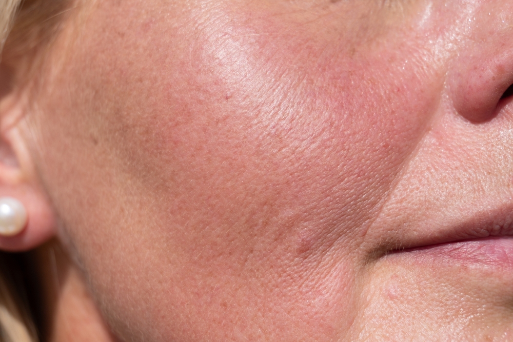 laser peel in laplace dermatology