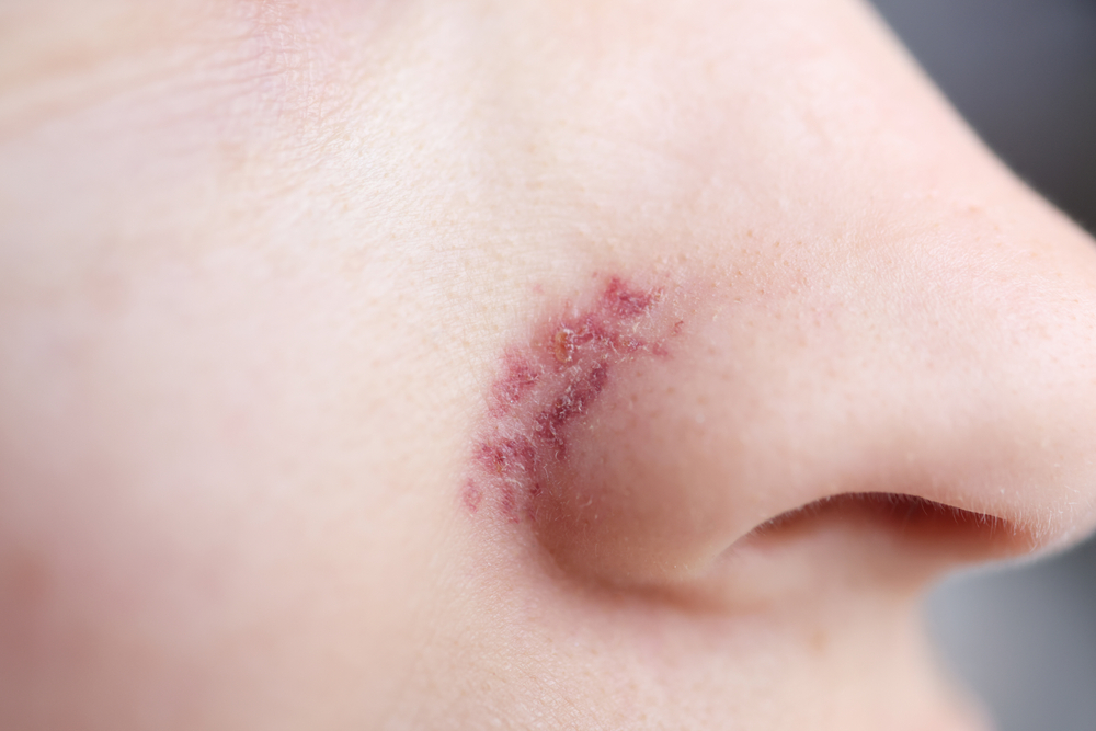 spider veins treatment at laplace dermatology