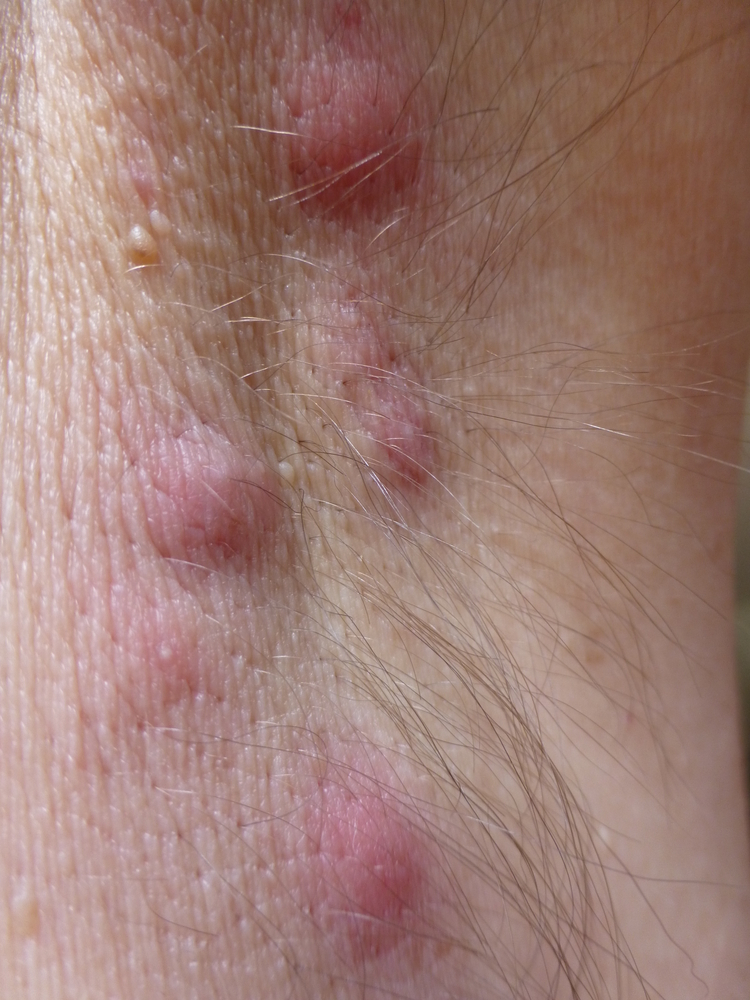 hidradenitis suppurativa boils - laplace dermatologist