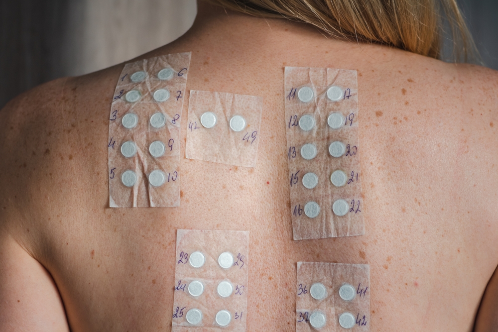 skin allergy patch test - allergy treatment in laplace - laplace dermatologist