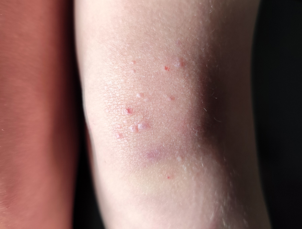 Explore Professional Treatment for Molluscum Bumps​ - dermatologist in laplace