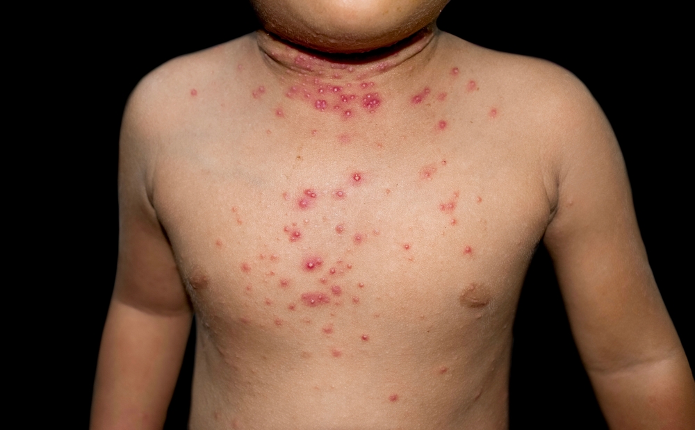 Find Gentle Molluscum Care for Children - laplace dermatologist
