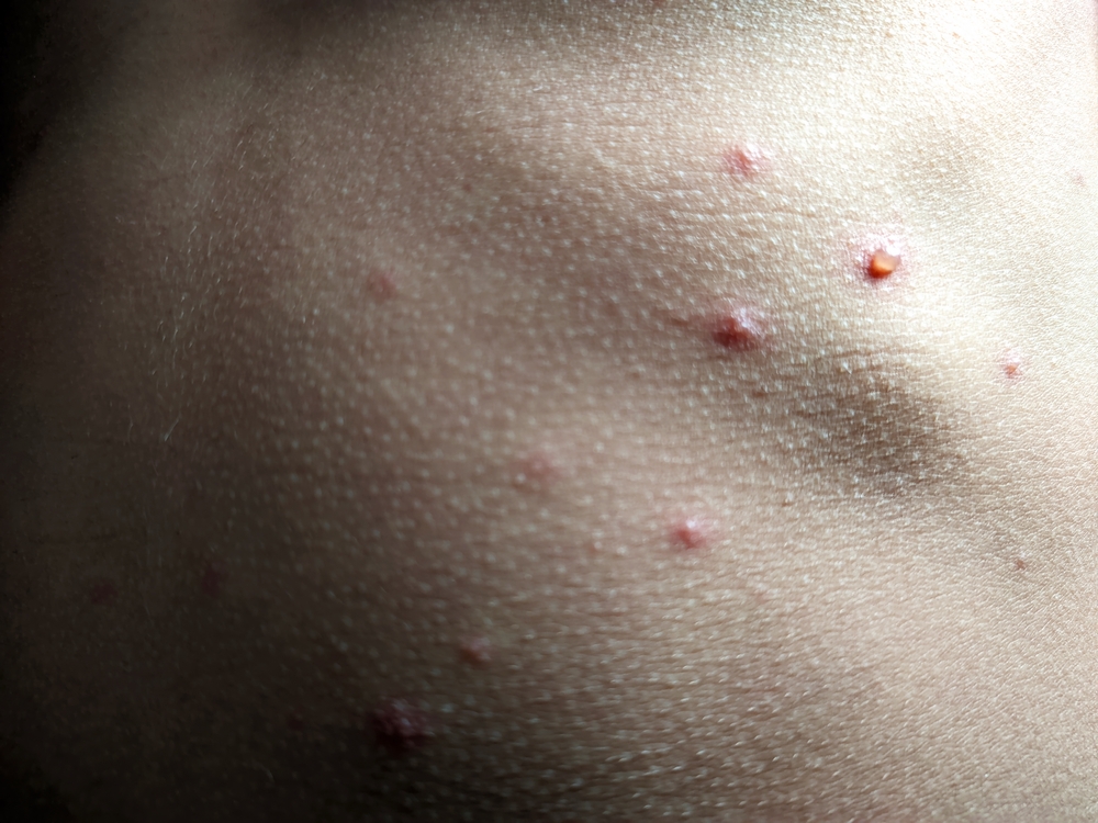 Get a Clear Diagnosis From a Dermatologist about molluscum contagiosum