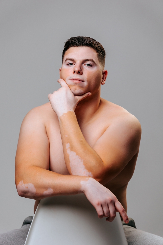 Get a Clear Diagnosis for White Skin Patches - vitiligo treatment in laplace