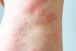 Why Does Eczema Flare Up in the Fall - laplace dermatologist