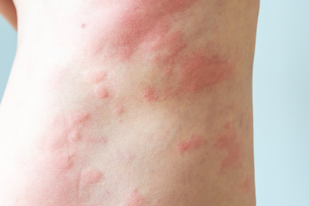 Why Does Eczema Flare Up in the Fall - laplace dermatologist