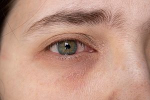 Why Are Your Eyelids Itchy and Puffy During Fall - dermatologist in laplace